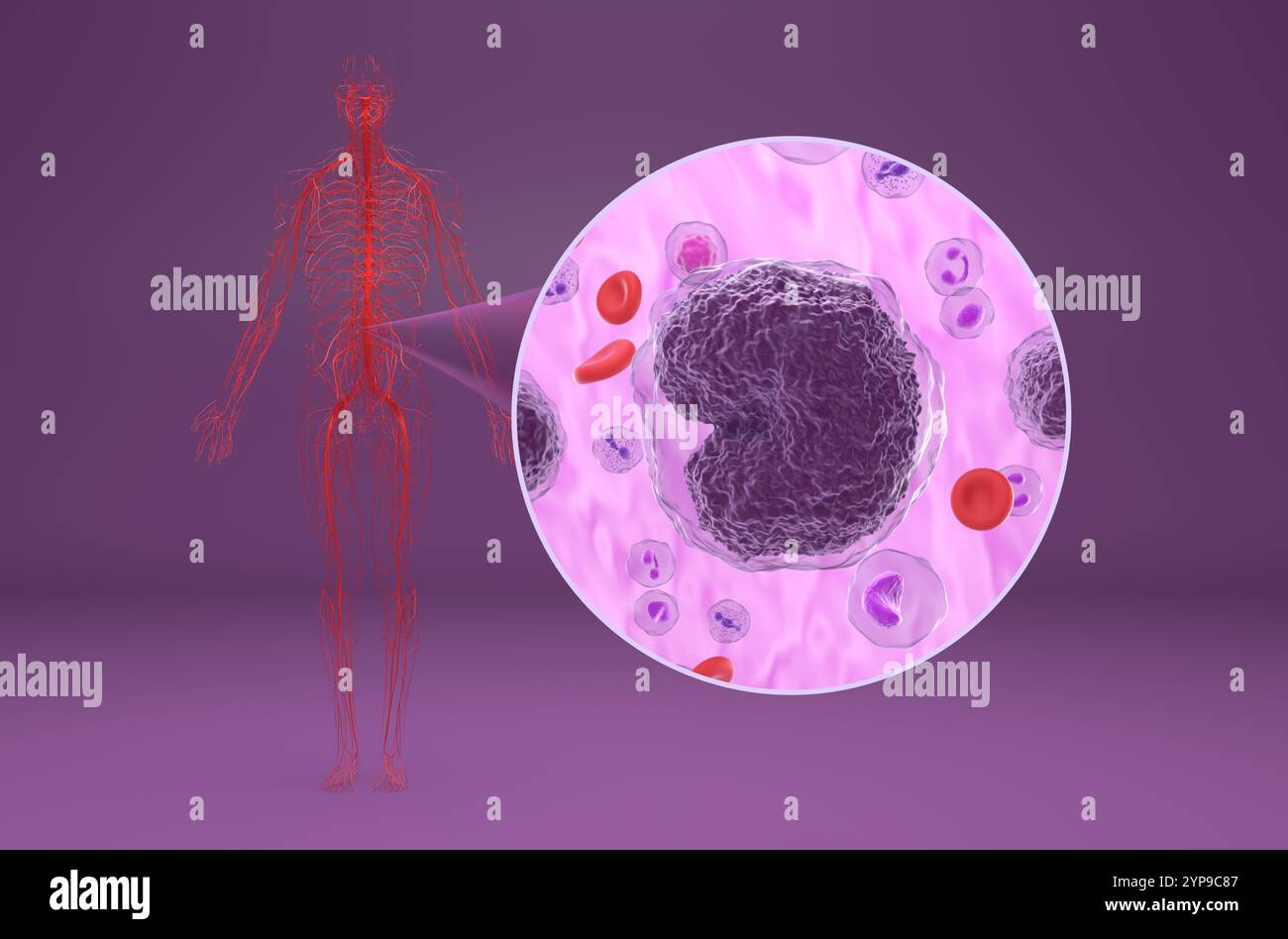 Linfoma non-hodgkin (NHL) - Vista isometrica illustrazione 3d. Foto Stock