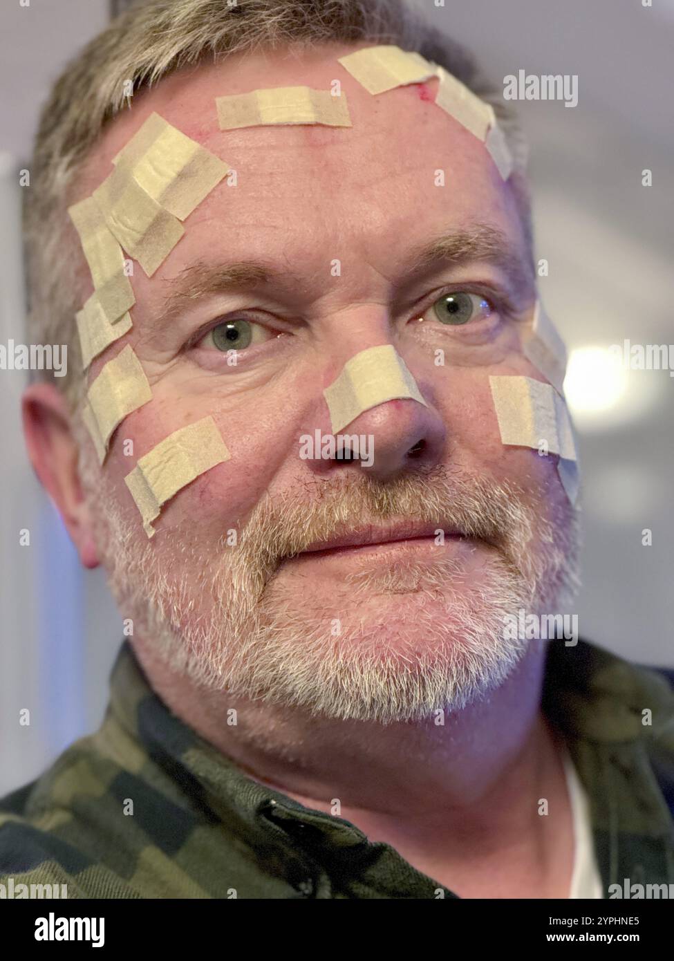 Uomo con molte piccole macchie di ferita sul viso, dopo un trattamento laser al dermatologo, per carcinoma basocellulare, cancro della pelle bianca, s sospettoso Foto Stock