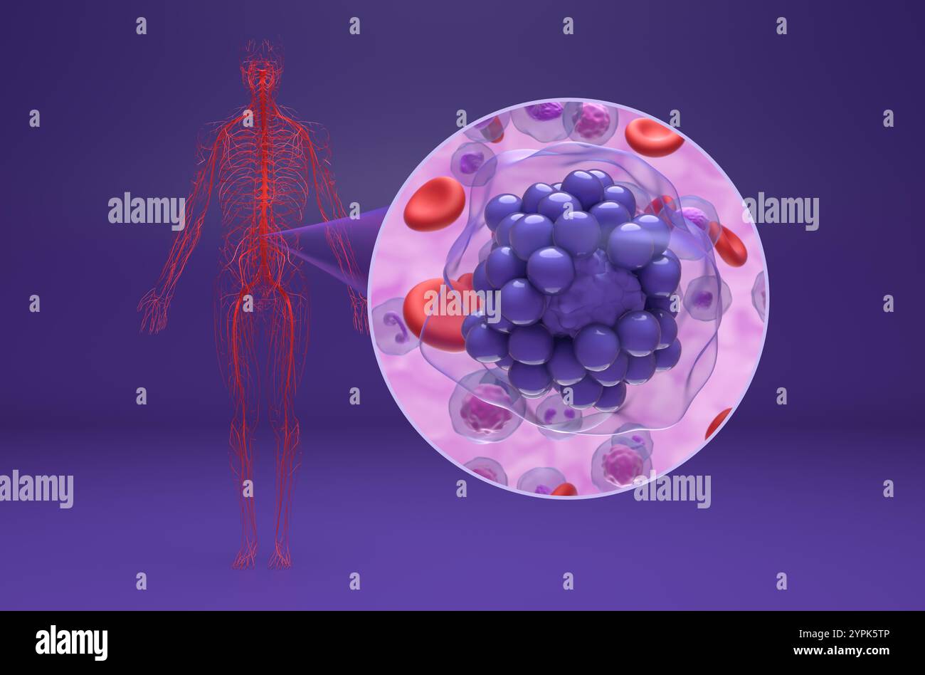 Linfoma diffuso a grandi cellule B (DLBCL) - Vista isometrica illustrazione 3d. Foto Stock