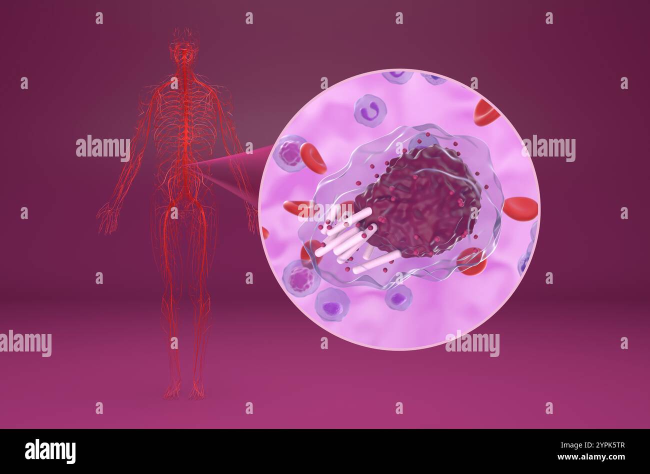 Leucemia linfocitica cronica (CLL) - Vista isometrica illustrazione 3d. Foto Stock