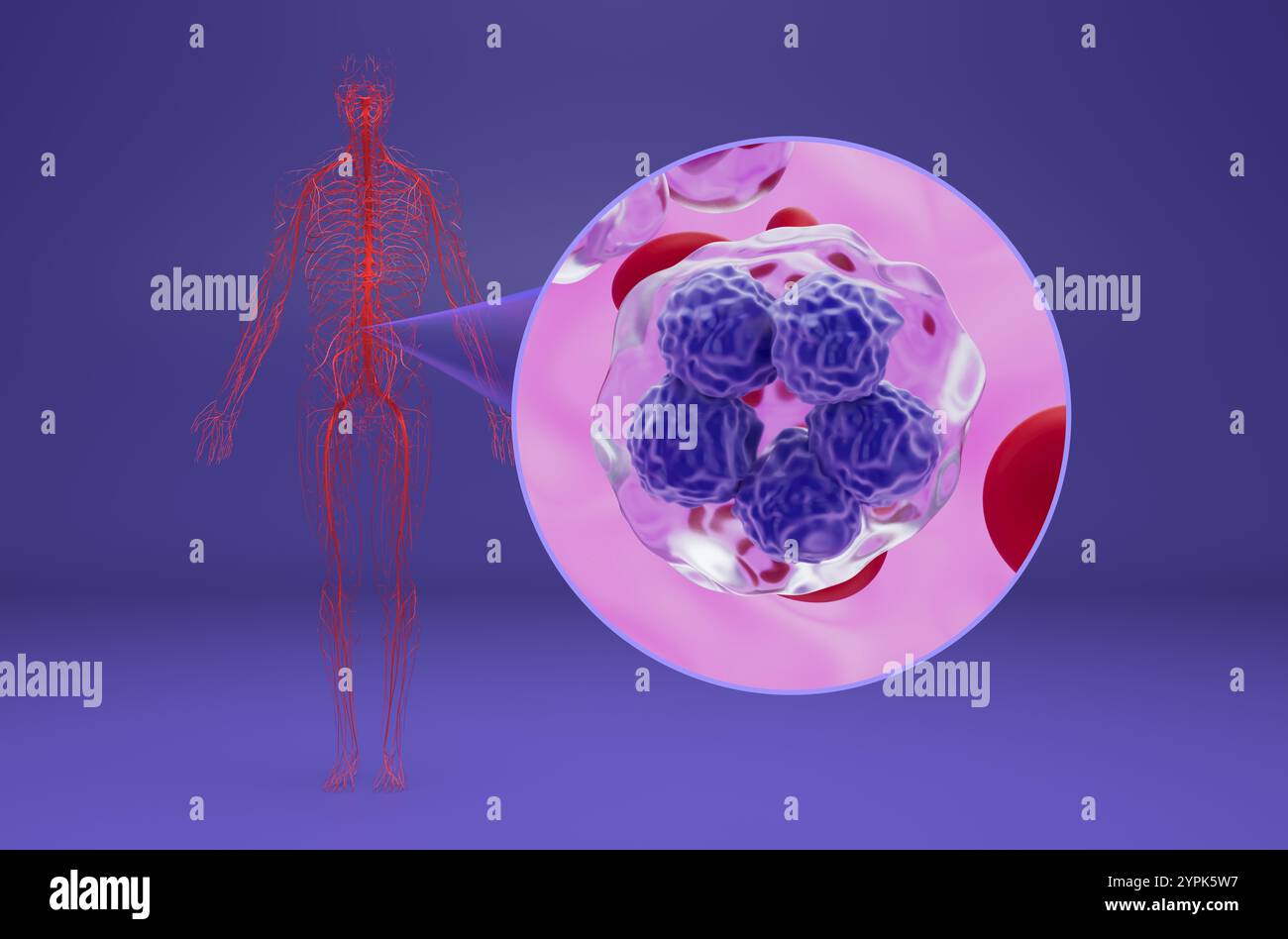 Linfoma a cellule T - Vista isometrica illustrazione 3d. Foto Stock
