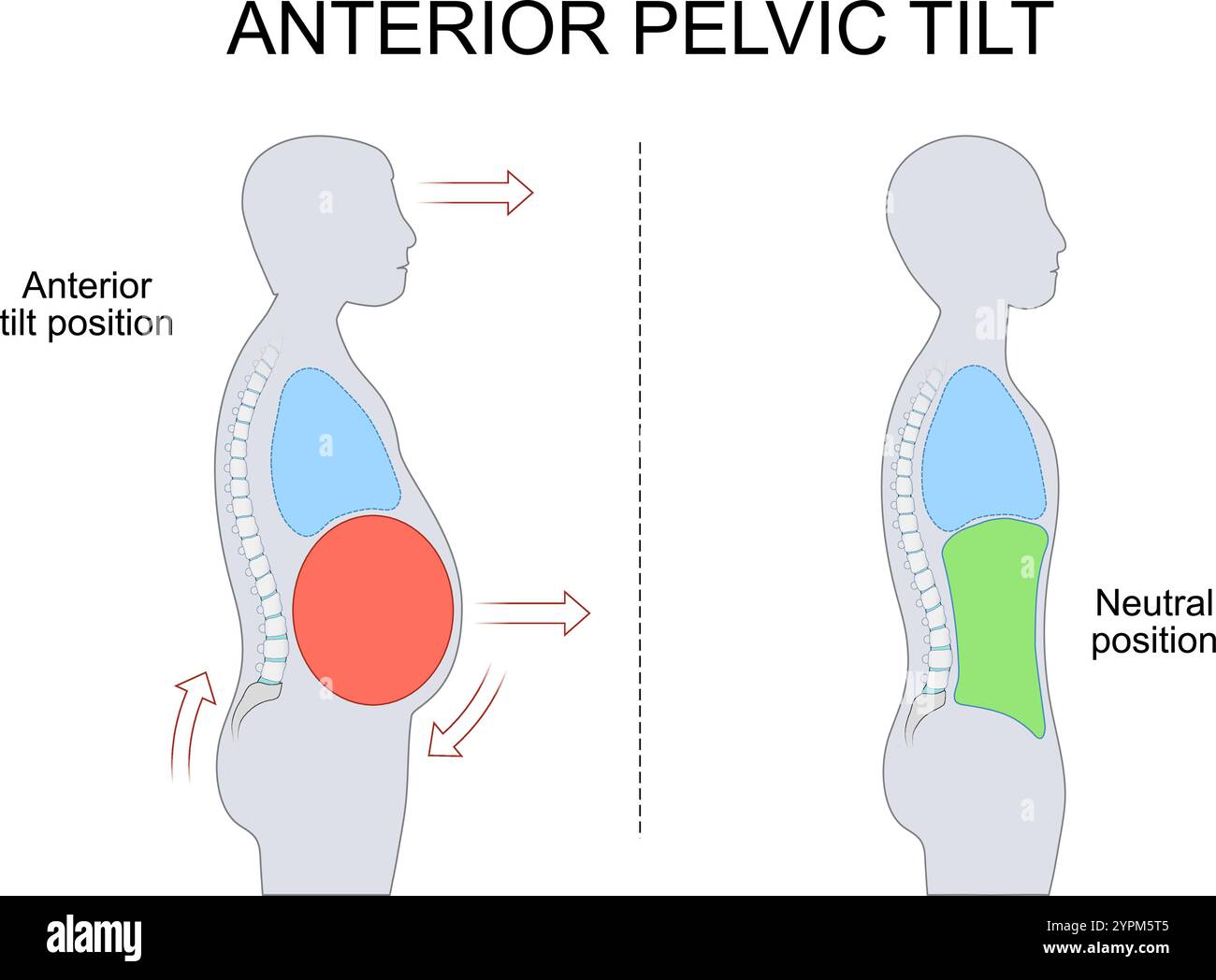 Inclinazione pelvica anteriore. Rotazione pelvica. Lordosi lombare. Squilibrio posturale. Debolezza muscolare addominale. Mal di schiena. Terapia fisica. Corre pelvico Illustrazione Vettoriale