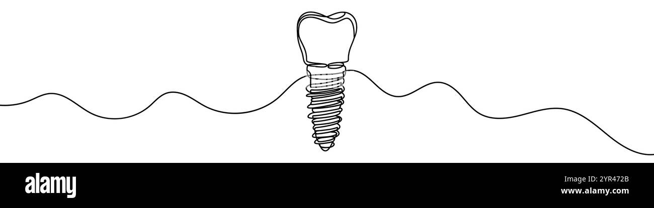 Un'illustrazione a linea continua dell'impianto dentale, isolato su sfondo bianco. Line art dell'impianto dentale Illustrazione Vettoriale