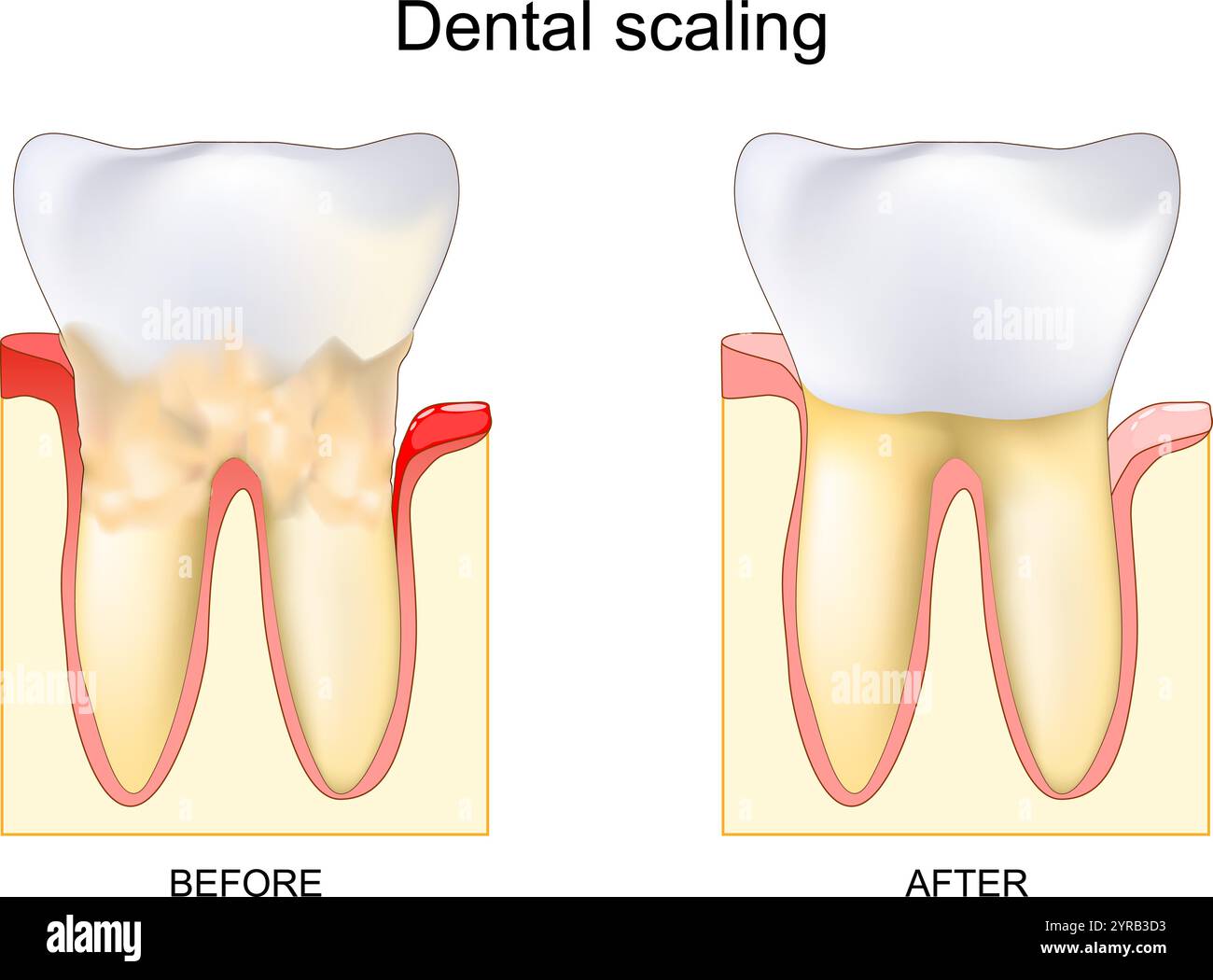 Procedura dentale per la rimozione del tartaro prima e dopo. Calcolo dentale. Pulizia o incrostazione professionale. Malattia gengivale. Infiammazione gengivale vicino a Bact Illustrazione Vettoriale