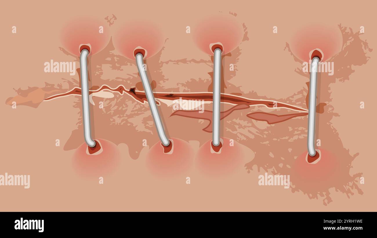 Chirurgia incisione, concetto di chirurgia medica Illustrazione Vettoriale