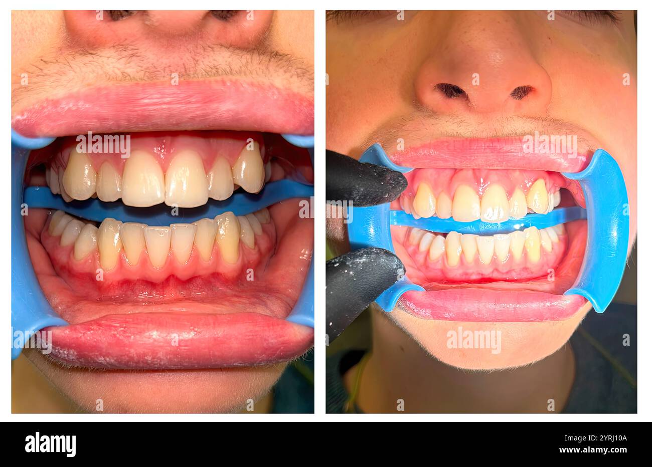 Divaricatore Per Guance Labbra Oringer Medio Retrattori - Foto 5