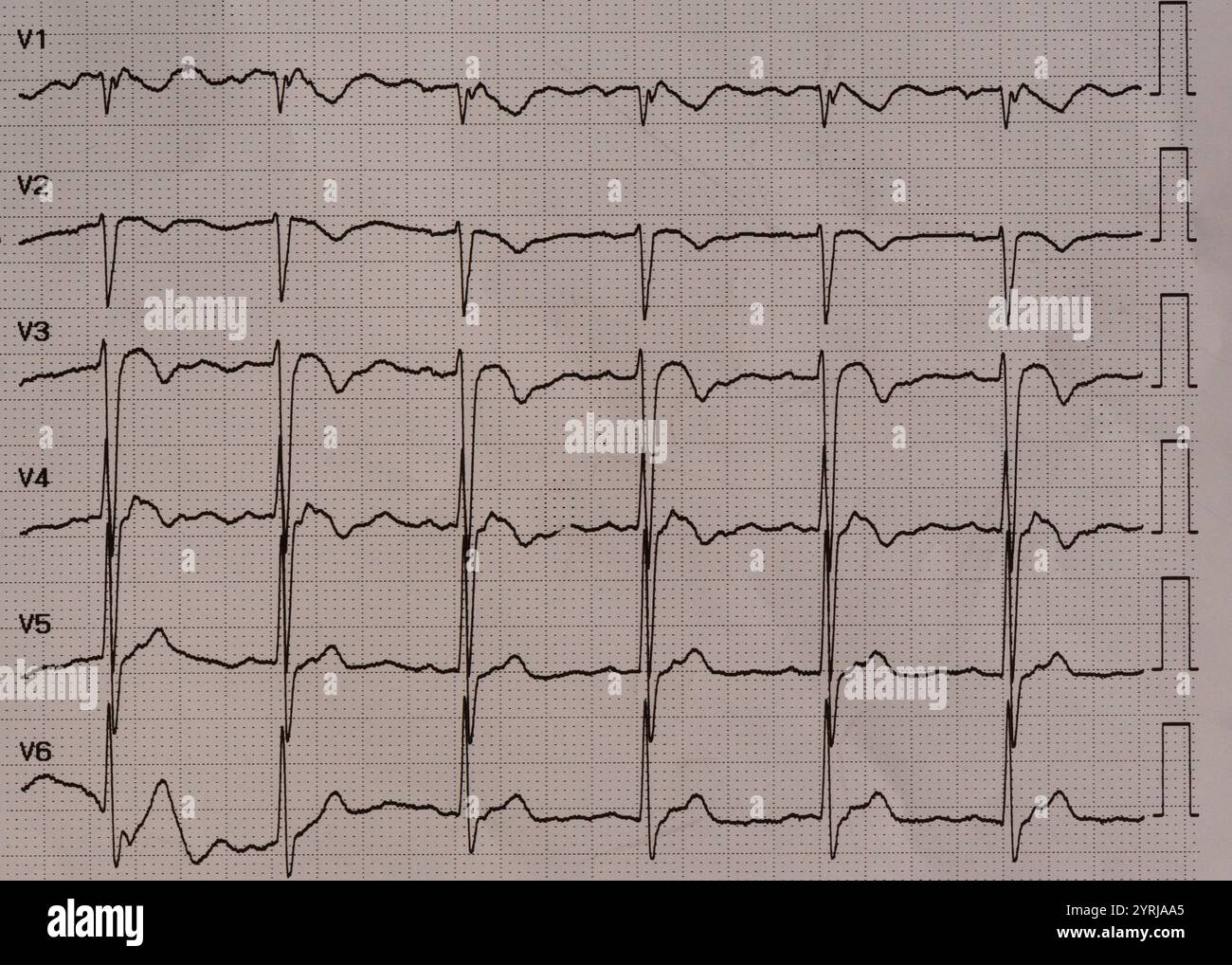 Un elettrocardiogramma che mostra più derivazioni con forme d'onda T invertite in V1- a V4 che indica ischemia miocardica da stenosi coronarica. Foto Stock
