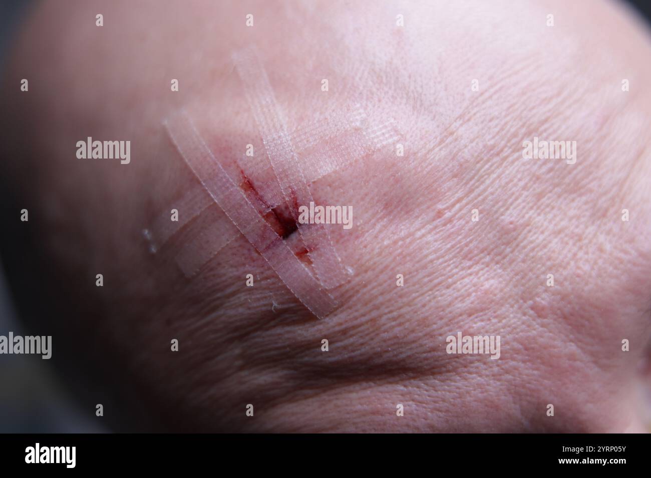 Lesione della testa ematoma e taglio. Lesione da trauma cranico. Foto Stock