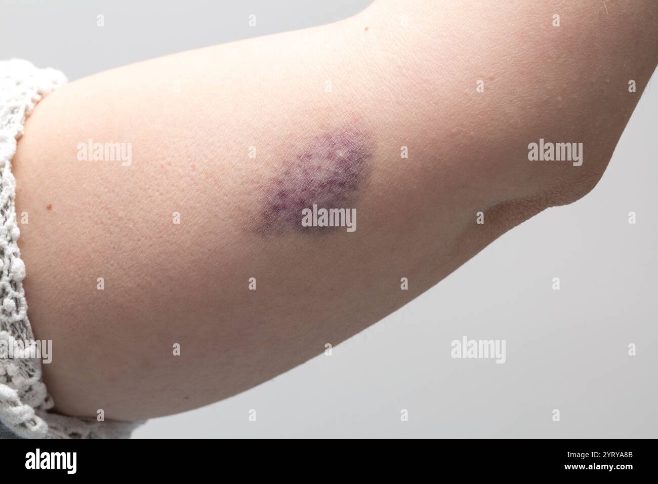 Primo piano di un forte livido o ematoma che si forma sul braccio del paziente dopo un'iniezione endovenosa Foto Stock