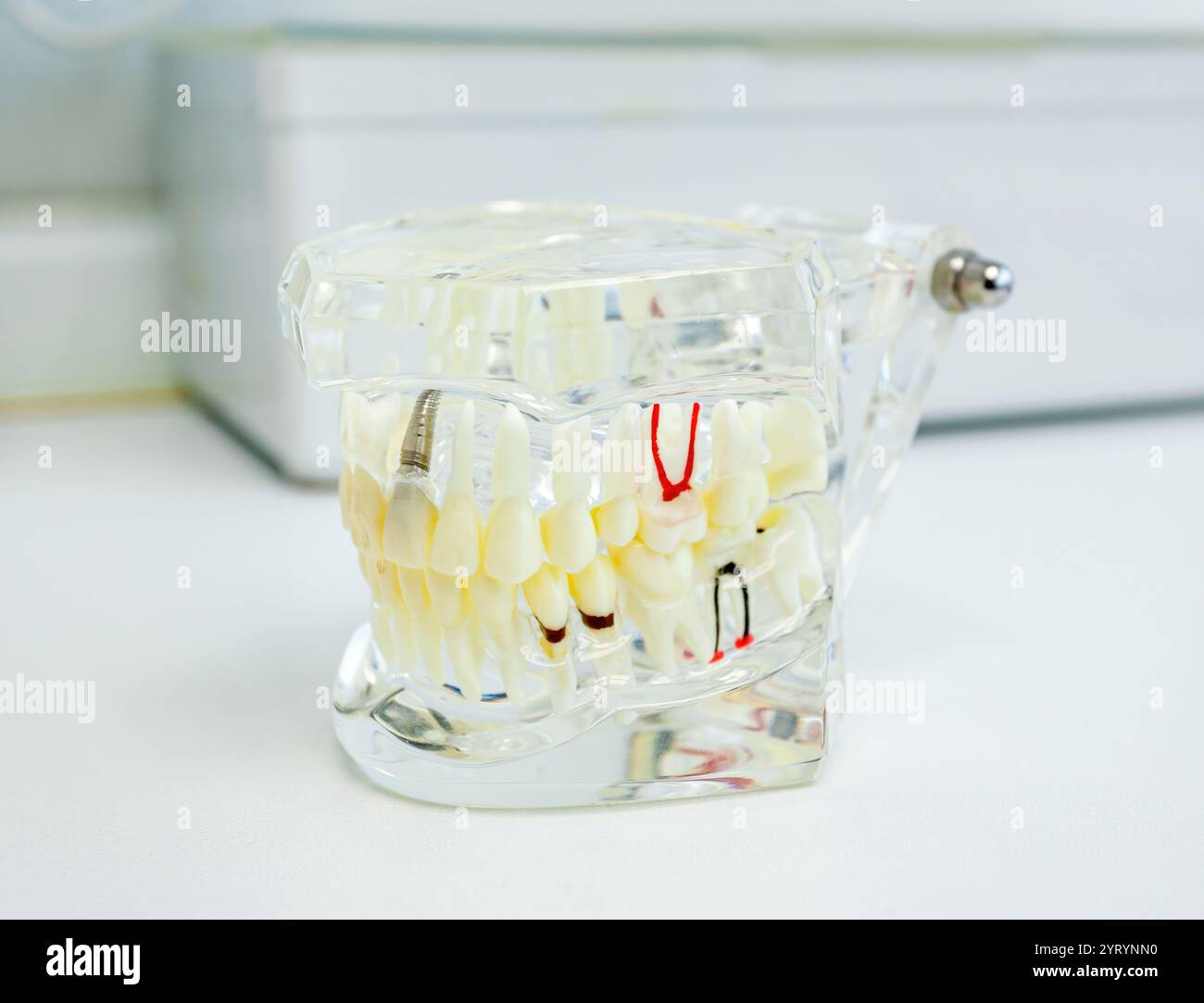 Modello anatomico trasparente della mandibola umana con impianti che mostrano denti, gengive e struttura ossea, perfetto per l'educazione odontoiatrica e la comunicazione del paziente Foto Stock