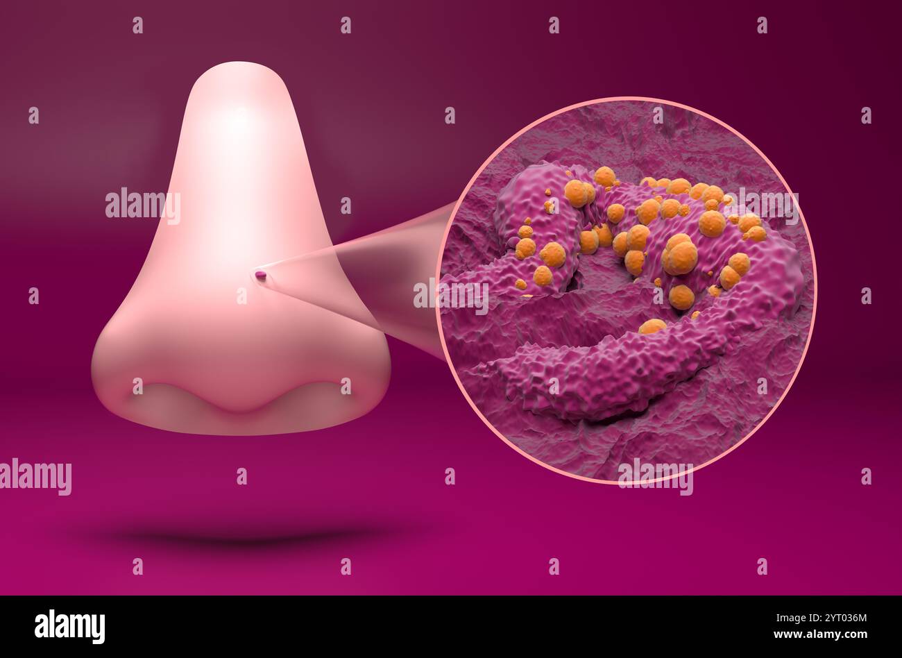 Carcinoma basale a cellule (BCC) - visualizzazione isometrica illustrazione 3d. Foto Stock