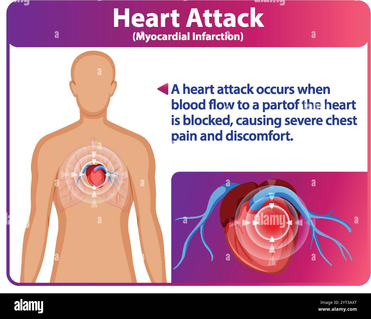 Illustrazione dell'attacco di cuore e dei suoi effetti Illustrazione Vettoriale