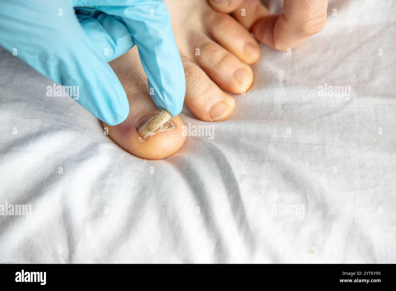 Primo piano di un'unghia del piede danneggiata esaminata con i guanti in ambienti chiusi. Evidenzia l'assistenza medica, l'igiene e l'attenzione a una possibile infezione fungina Foto Stock