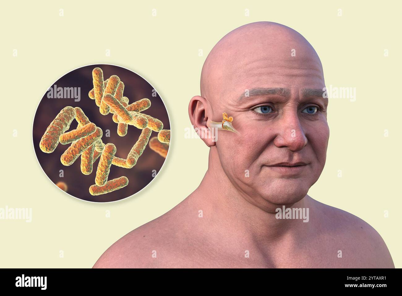 Illustrazione al computer di un uomo con pelle trasparente che rivela otite media (infezione dell'orecchio medio) e una vista ravvicinata dei batteri che l'hanno causata. Foto Stock