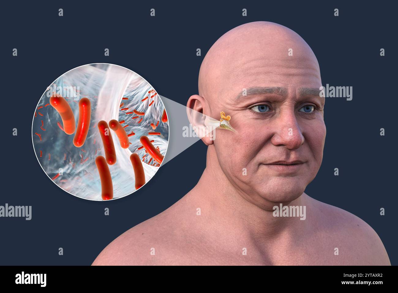 Illustrazione al computer di un uomo con pelle trasparente che rivela otite media (infezione dell'orecchio medio) e una vista ravvicinata dei batteri che l'hanno causata. Foto Stock