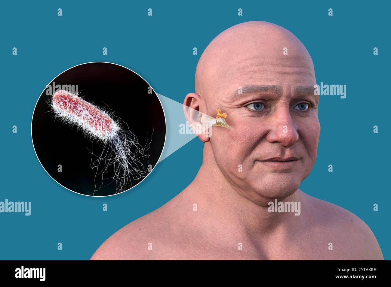 Illustrazione al computer di un uomo con pelle trasparente che rivela otite media (infezione dell'orecchio medio) e una vista ravvicinata dei batteri Pseudomonas aeruginosa. Foto Stock