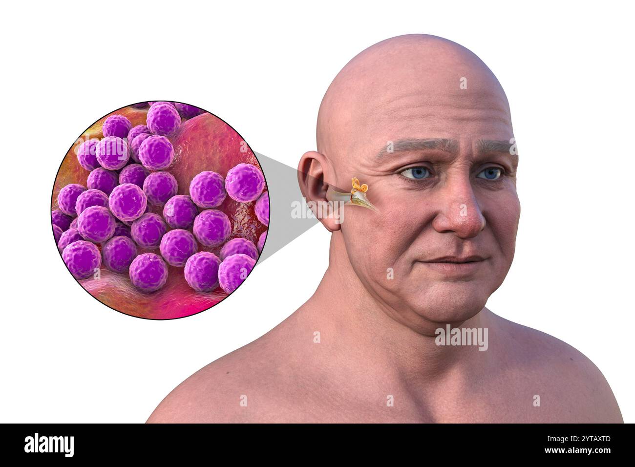 Illustrazione al computer di un uomo con pelle trasparente che rivela otite media (infezione dell'orecchio medio) e una vista ravvicinata dei batteri Staphylococcus aureus. Foto Stock