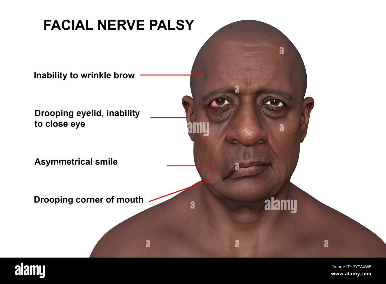 Paralisi facciale in un uomo. Illustrazione computerizzata che evidenzia l'asimmetria e il gocciolamento dei muscoli facciali su un lato del viso in paralisi facciale. Foto Stock