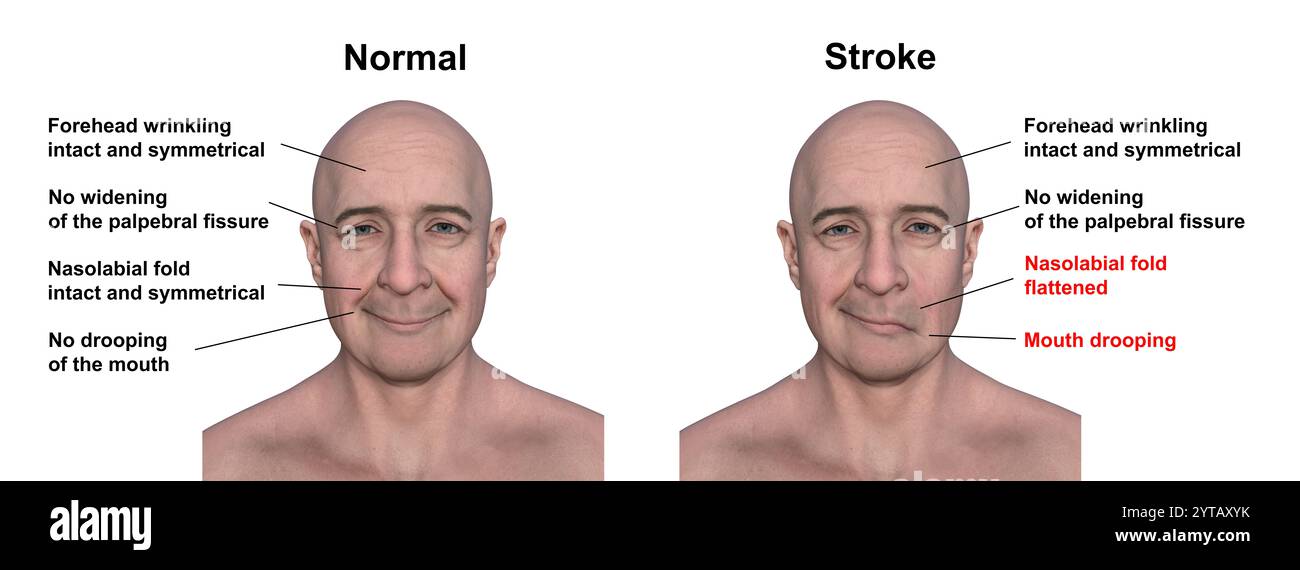 Illustrazione computerizzata di un uomo che mostra colpo lato sinistro, con bocca gocciolante e piega nasolabiale piatta, e la stessa persona sana. Foto Stock