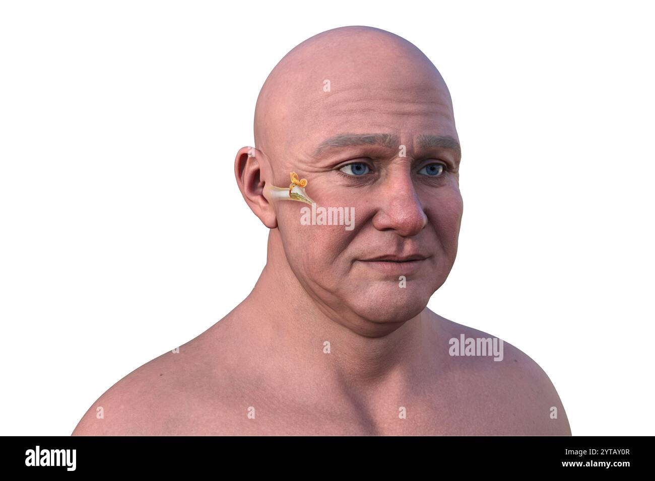 Illustrazione al computer di un uomo con pelle trasparente, che rivela otite media (infezione dell'orecchio medio) e accumulo di pus nell'orecchio medio. Foto Stock