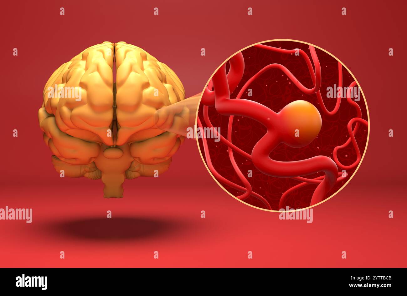 Aneurisma cerebrale - Vista isometrica illustrazione 3d. Foto Stock