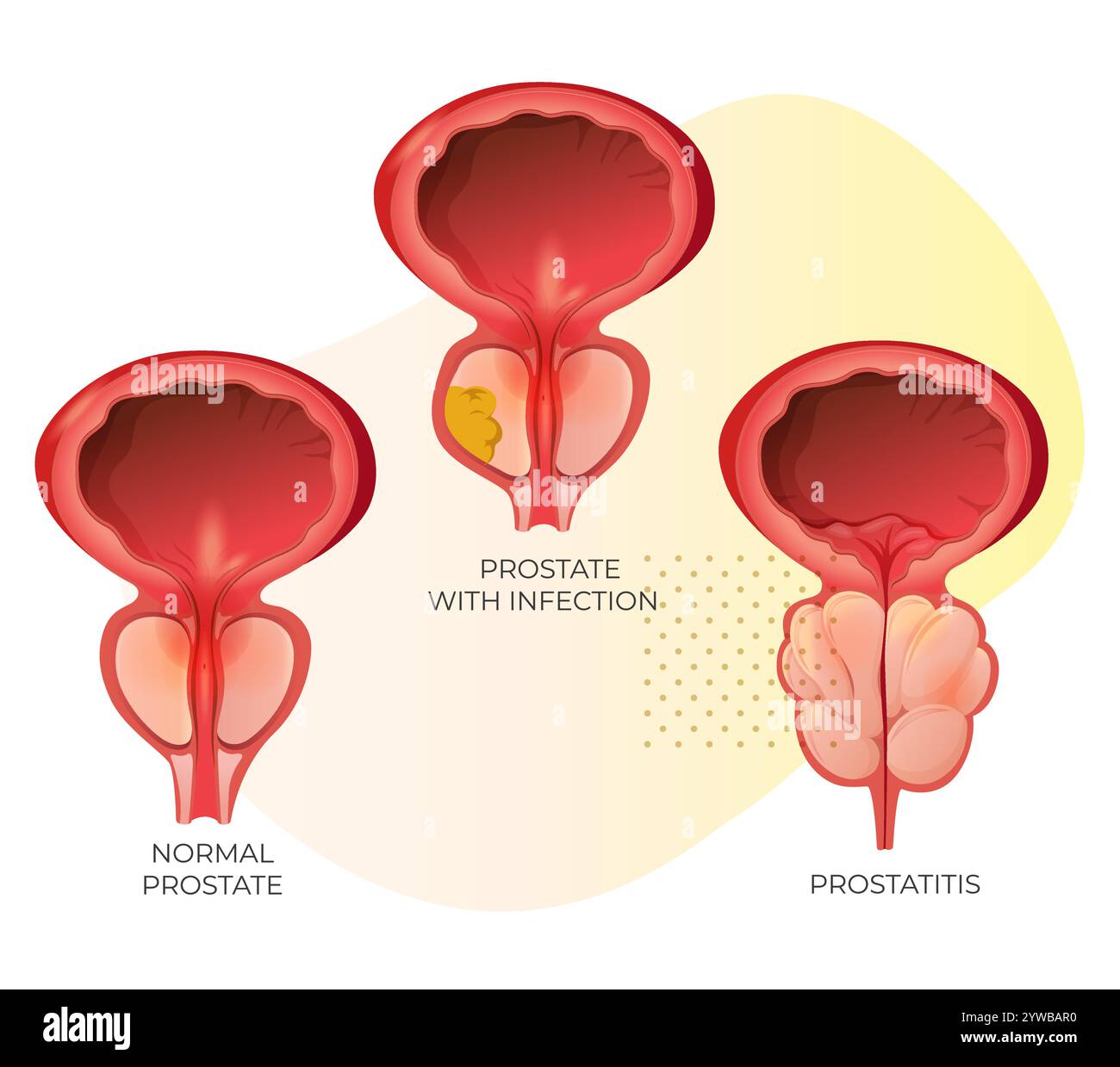 Prostata normale, prostata con infezione e ghiandola prostatica ingrandita sotto vescica - illustrazione stock come file EPS 10 Illustrazione Vettoriale