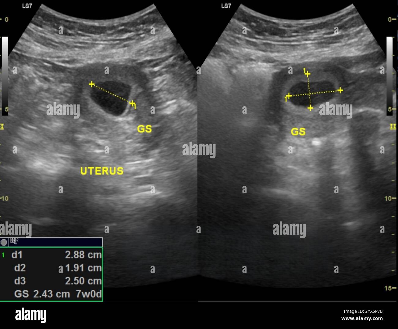 Ecografie di un utero che mostrano il sacco gestazionale (GS) intorno a un embrione umano di 7 settimane. Il sacco gestazionale si forma circa 5 - 7 settimane dopo l'ultimo periodo mestruale. Diventerà la placenta, l'organo temporaneo che collega un feto alla madre. Foto Stock