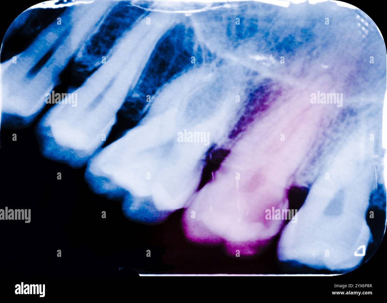 Raggi X periapicali colorati delle cavità, o carie, in un secondo molare mandibolare in alto a sinistra (il secondo da destra). Una radiografia periapicale mostra l'intero dente, dalla corona alla punta della radice. Foto Stock