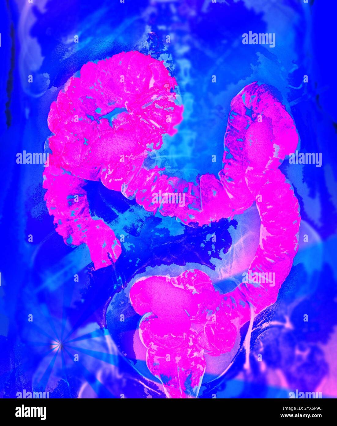 Radiografia frontale colorata di un colon sano (intestino crasso). Il colon è la parte finale del tratto digerente, dove l'acqua viene assorbita dal cibo digerito e si formano feci solide. Un mezzo di contrasto al bario è stato introdotto nel colon per renderlo visibile sui raggi X. Foto Stock