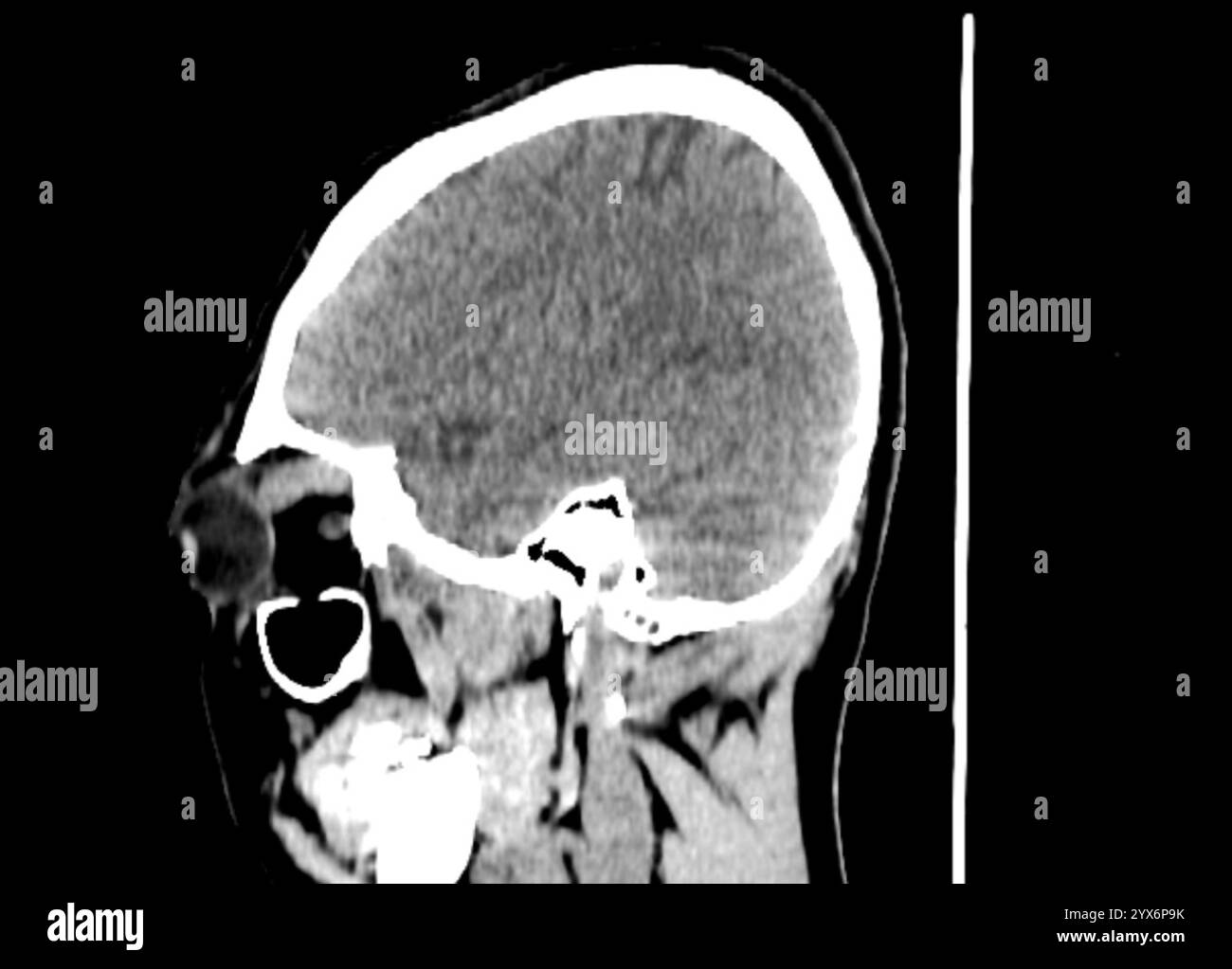 Tomografia computerizzata sagittale scansione TC della testa di un paziente con fistola carotide-cavernosa (CCF). Una CCF è un collegamento anomalo tra il sistema arterioso e venoso all'interno del seno cavernoso del cranio. Foto Stock