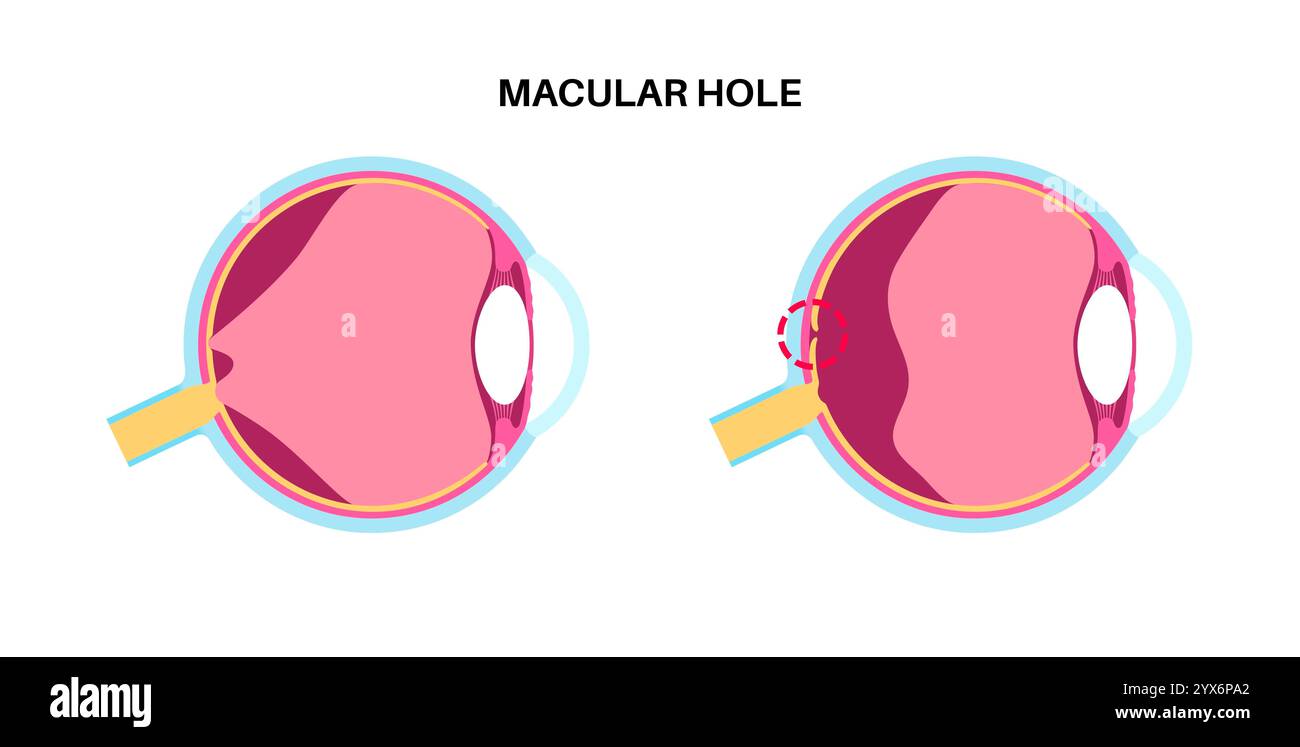 Malattia del buco maculare, illustrazione. Foto Stock