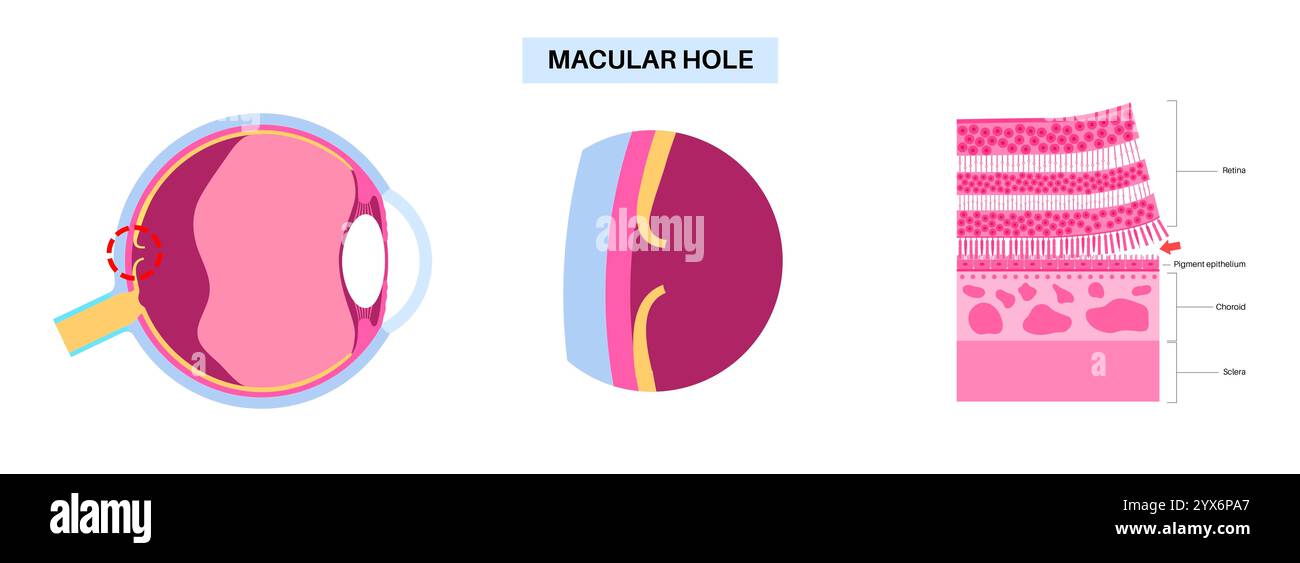 Malattia del buco maculare, illustrazione. Foto Stock