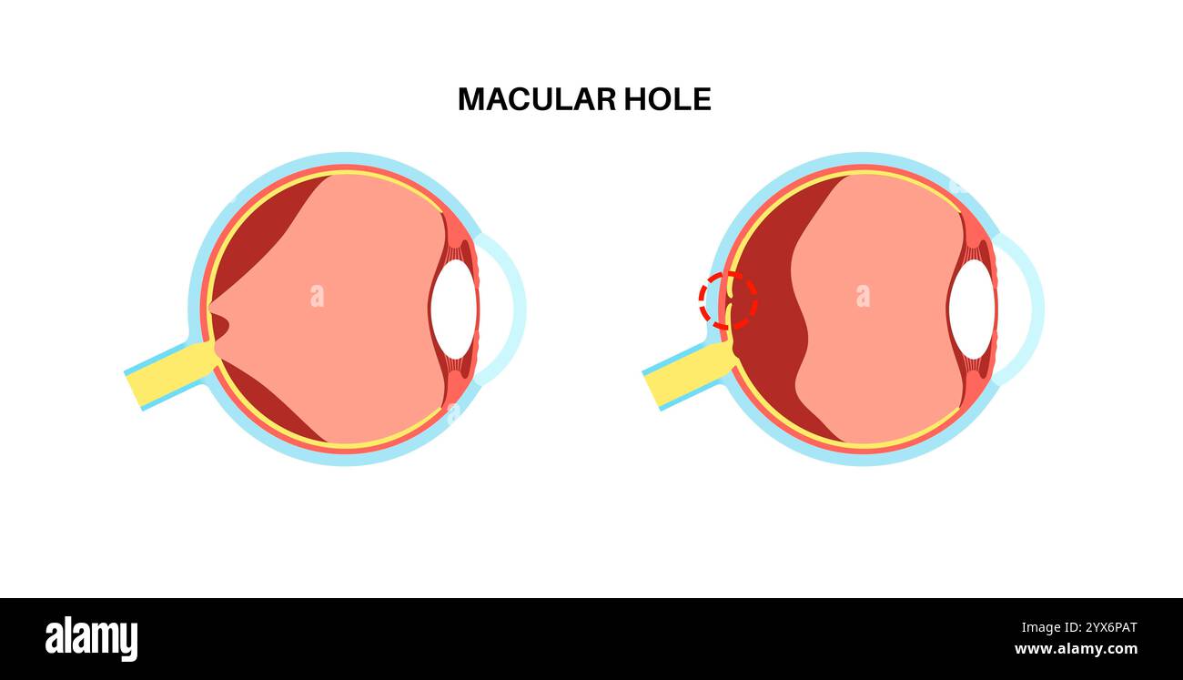 Malattia del buco maculare, illustrazione. Foto Stock
