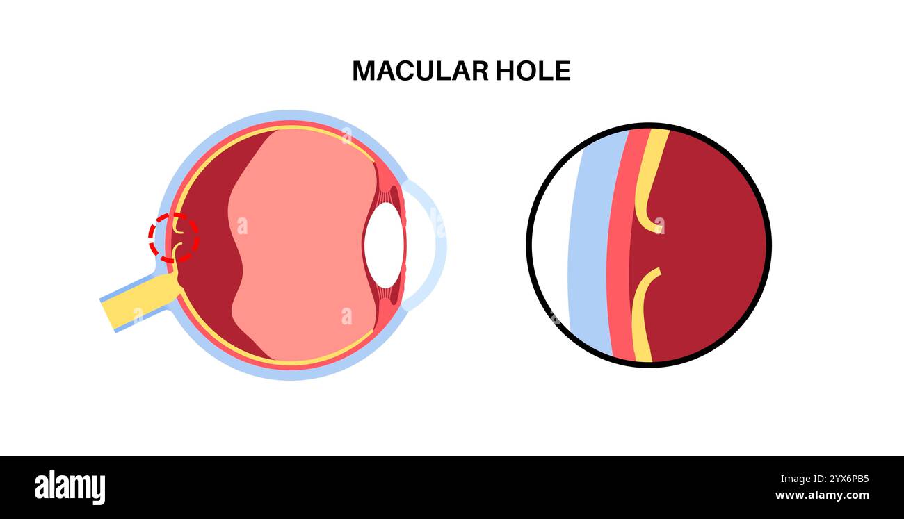 Malattia del buco maculare, illustrazione. Foto Stock