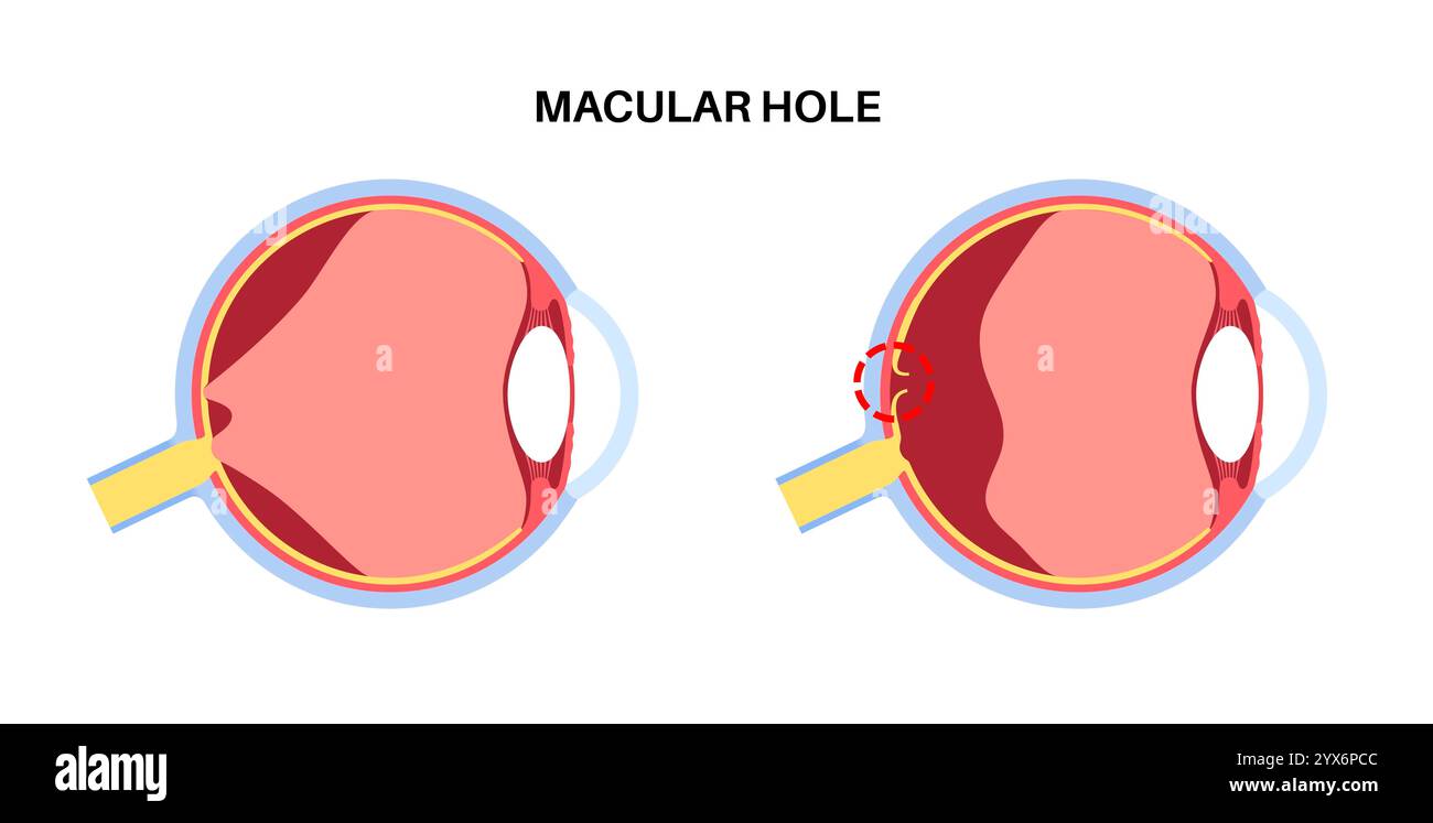 Malattia del buco maculare, illustrazione. Foto Stock