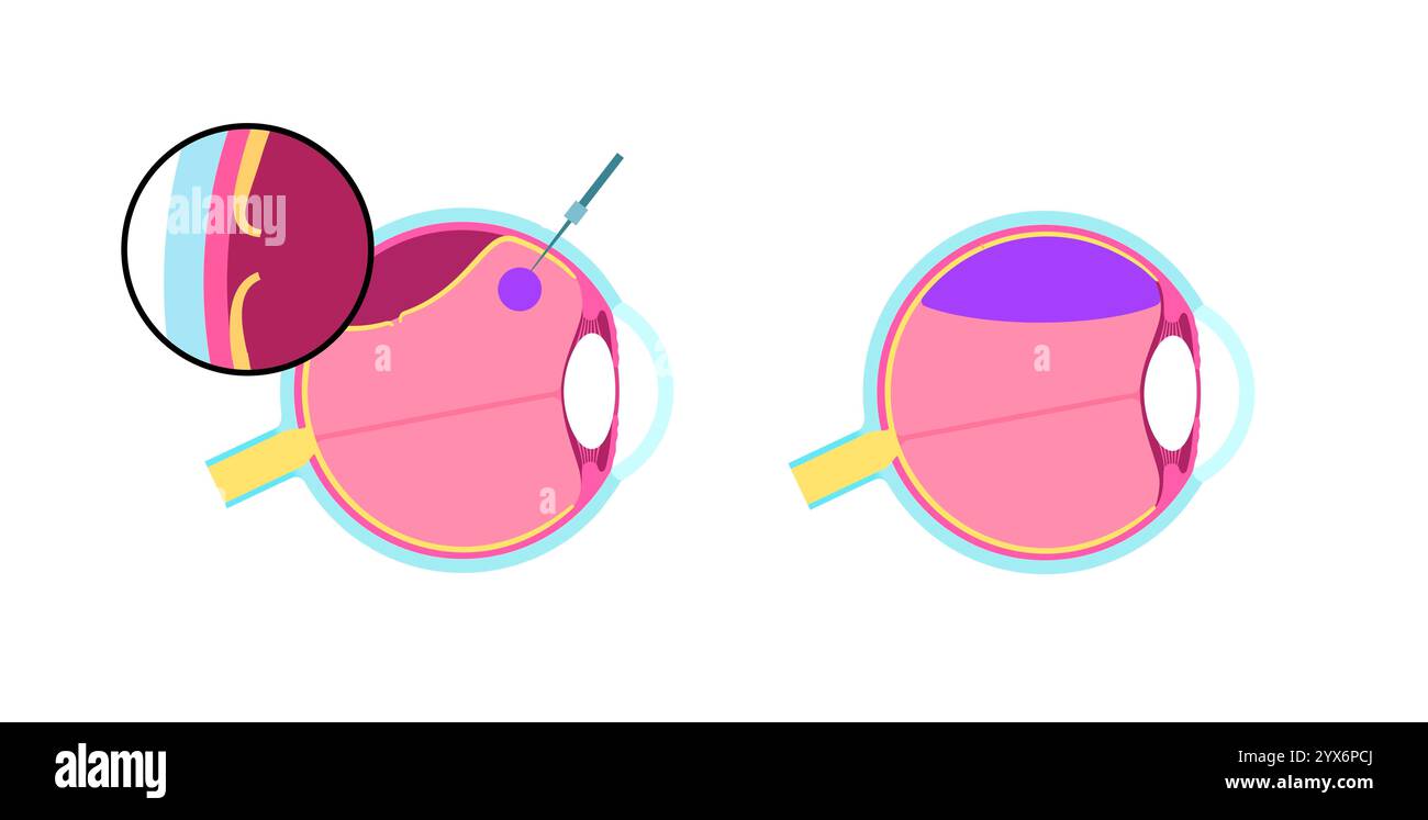 Retinopessia pneumatica, illustrazione. Si tratta di una procedura oculare minimamente invasiva per riparare il distacco della retina. Consiste nell'iniettare una bolla di gas nell'umore vitreo per ricollegare la retina, combinata con laser o crioterapia Foto Stock