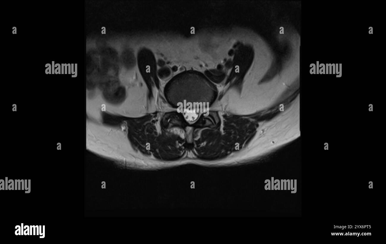 Scansione di risonanza magnetica assiale (MRI) di una colonna vertebrale sana. Foto Stock