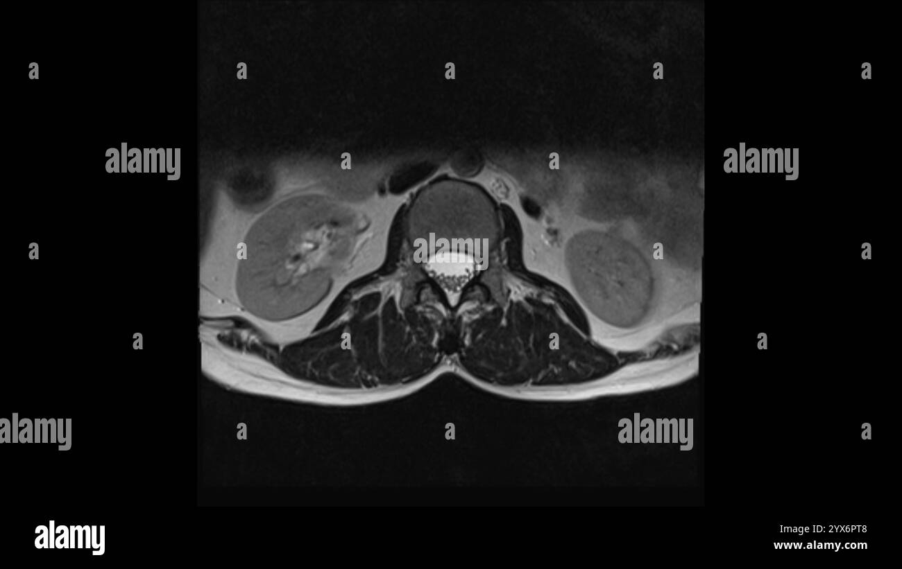 Scansione di risonanza magnetica assiale (MRI) di una colonna vertebrale sana. Foto Stock