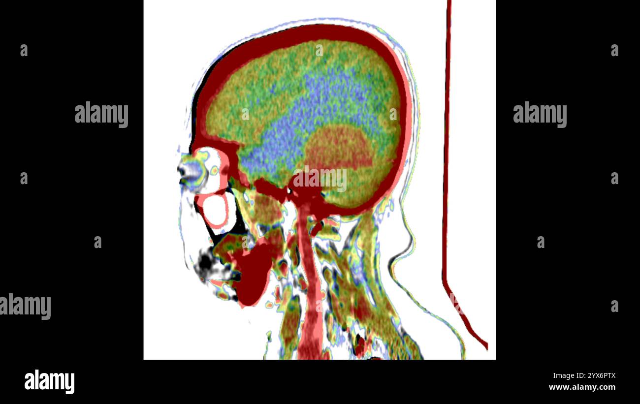 Tomografia computerizzata sagittale (TC) della testa di un paziente con meningioma (arancione, centro). Si tratta di un tumore benigno (non canceroso) che nasce dalle meningi, le membrane che circondano il cervello. Foto Stock