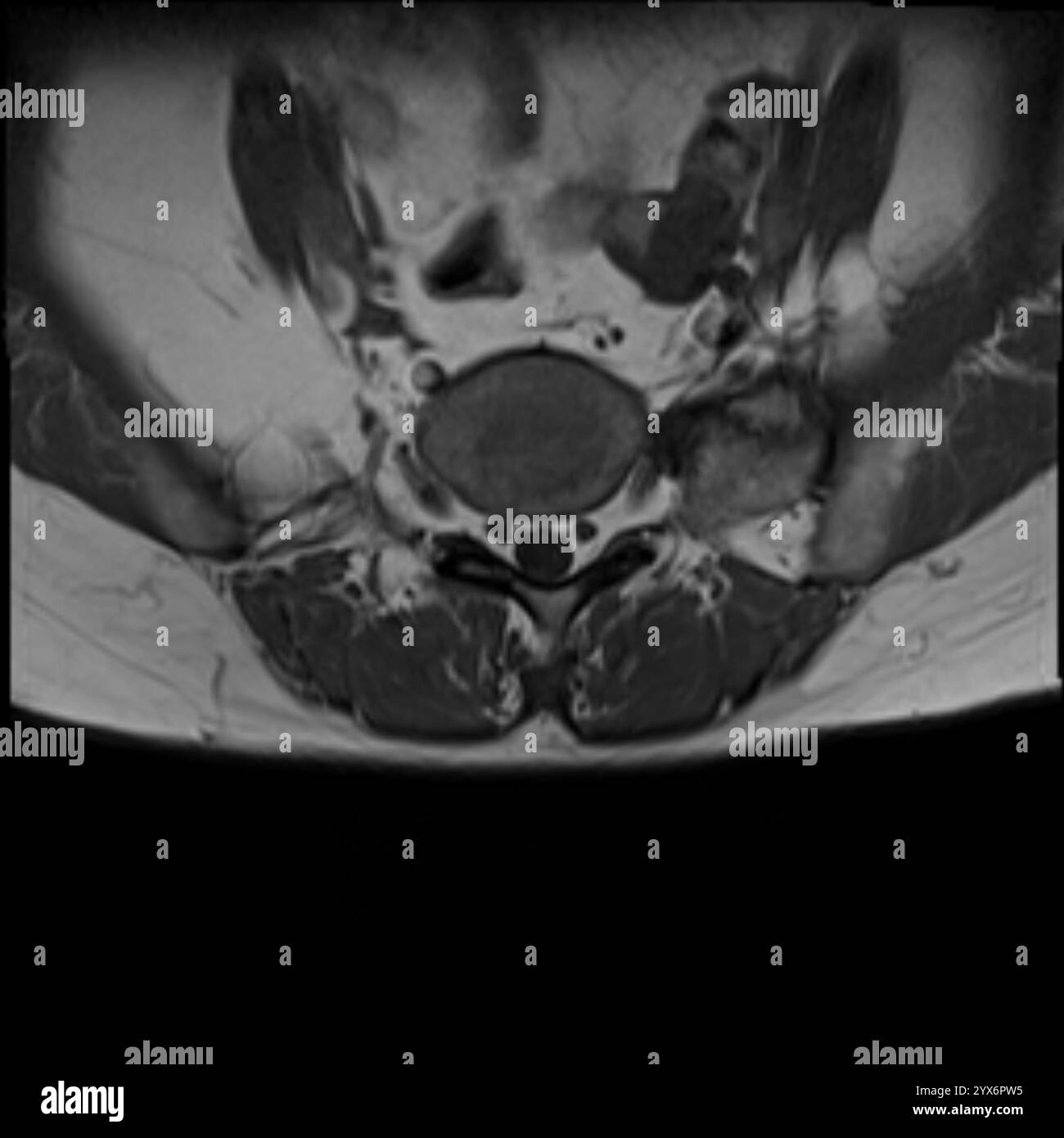 Scansione di risonanza magnetica assiale (MRI) di una colonna vertebrale sana. Foto Stock