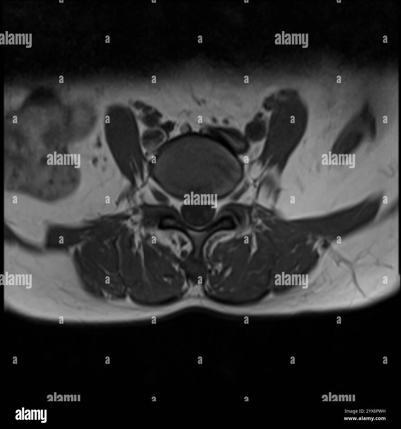 Scansione di risonanza magnetica assiale (MRI) di una colonna vertebrale sana. Foto Stock