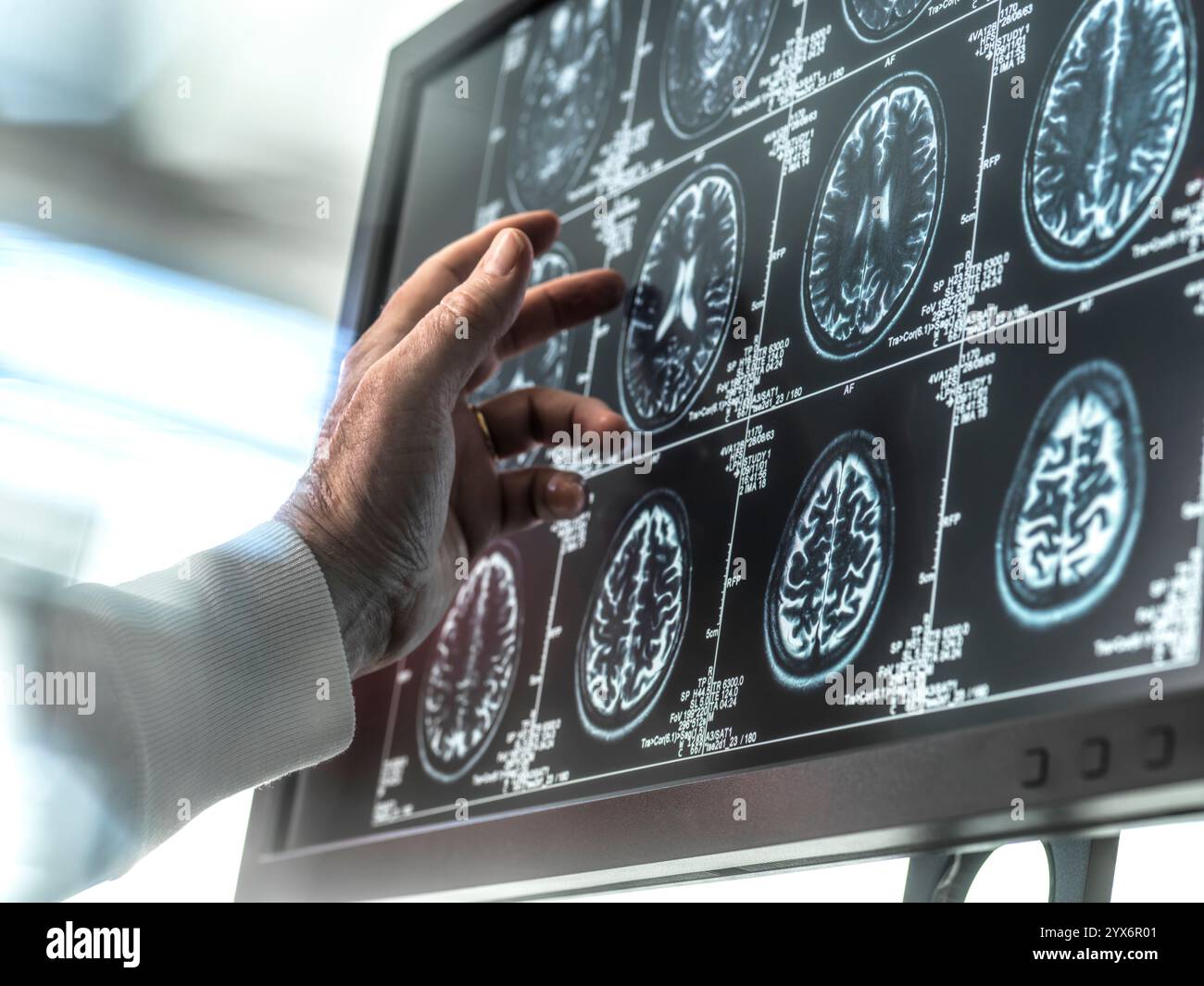 Lo scienziato che osserva la risonanza magnetica cerebrale di un paziente esegue la scansione per rilevare l'invecchiamento e i danni dovuti alla demenza e al morbo di Alzheimer. Foto Stock