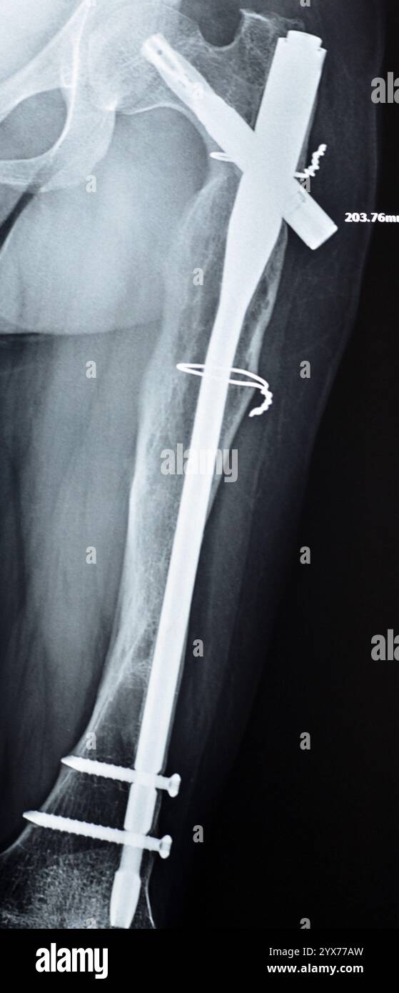 Radiografia che mostra interferenze operative con frattura dell'albero femorale LT trasformante con chiodo intra-midollare con formazione ossificata di callo e fissazione interna Foto Stock