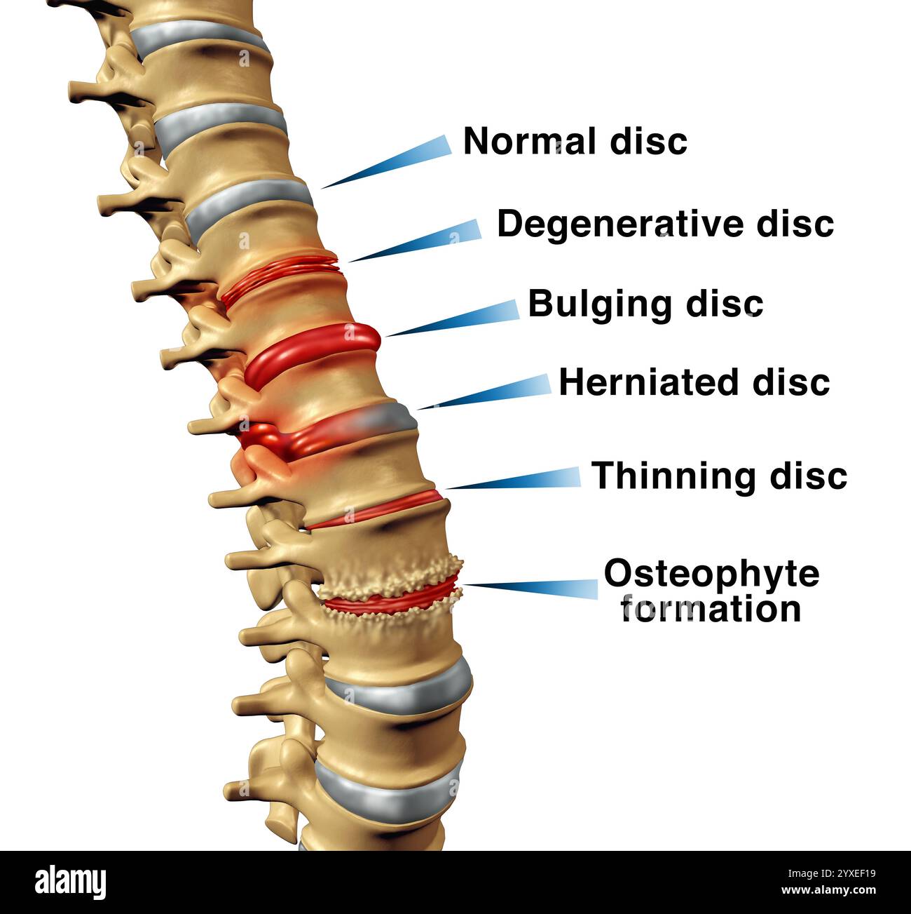 Disturbi della colonna vertebrale concetto di dolore alla schiena con disco degenerativo o rigonfiamento e dischi erniati o assottiglianti e formazione di osteofiti su una vertebra scheletrica AS Foto Stock
