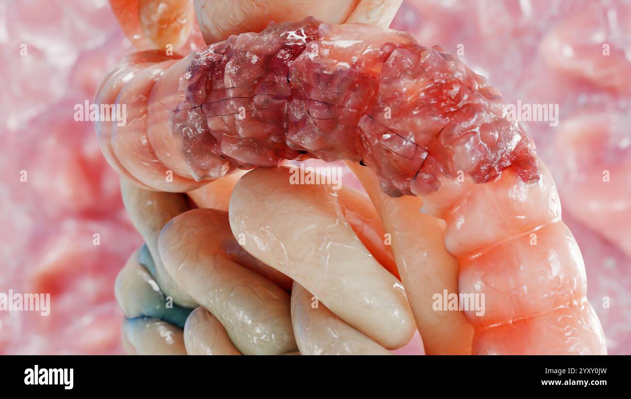 Cancro colorettale, tumore maligno dell'intestino, endoscopio all'interno della colonscopia, intestino intestinale, rimozione dei polipi del colon, ricerca dei polipi del colon, polipectomia, Foto Stock