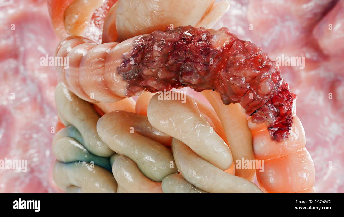 Cancro colorettale, tumore maligno dell'intestino, endoscopio all'interno della colonscopia, intestino intestinale, rimozione dei polipi del colon, ricerca dei polipi del colon, polipectomia, Foto Stock