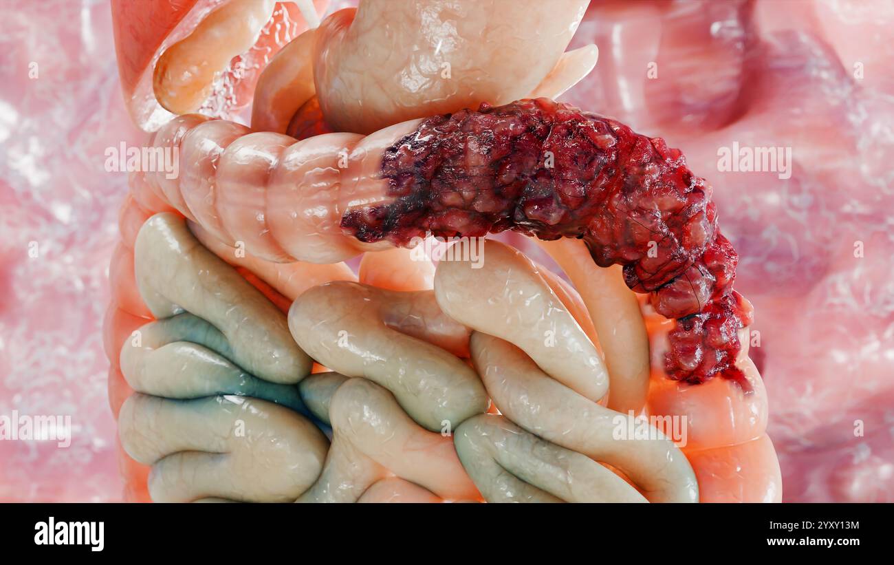 Cancro colorettale, tumore maligno dell'intestino, endoscopio all'interno della colonscopia, intestino intestinale, rimozione dei polipi del colon, ricerca dei polipi del colon, polipectomia, Foto Stock