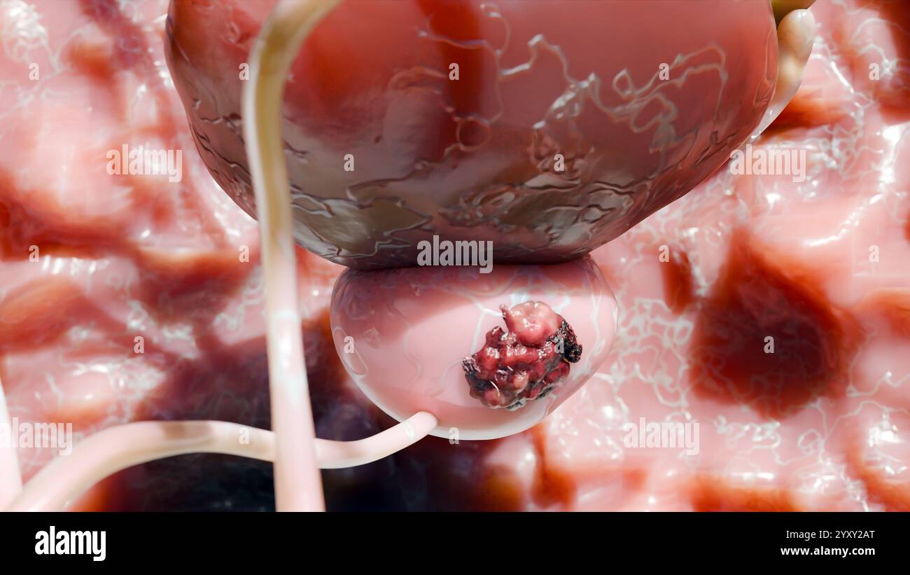 Stadi del cancro alla prostata. cellule ancerose, tumore maligno comprime l'uretra. Disturbo patologico, sistema riproduttivo genitale, canale alfa, bladd Foto Stock