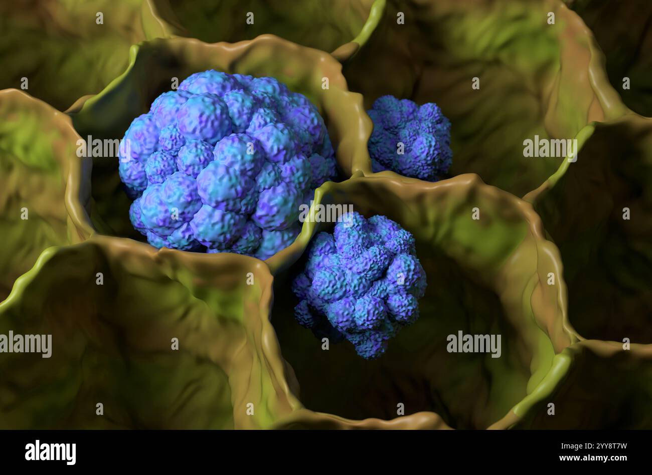 Cancro polmonare (LC) nella vista isometrica del tessuto polmonare illustrazione 3d. Foto Stock