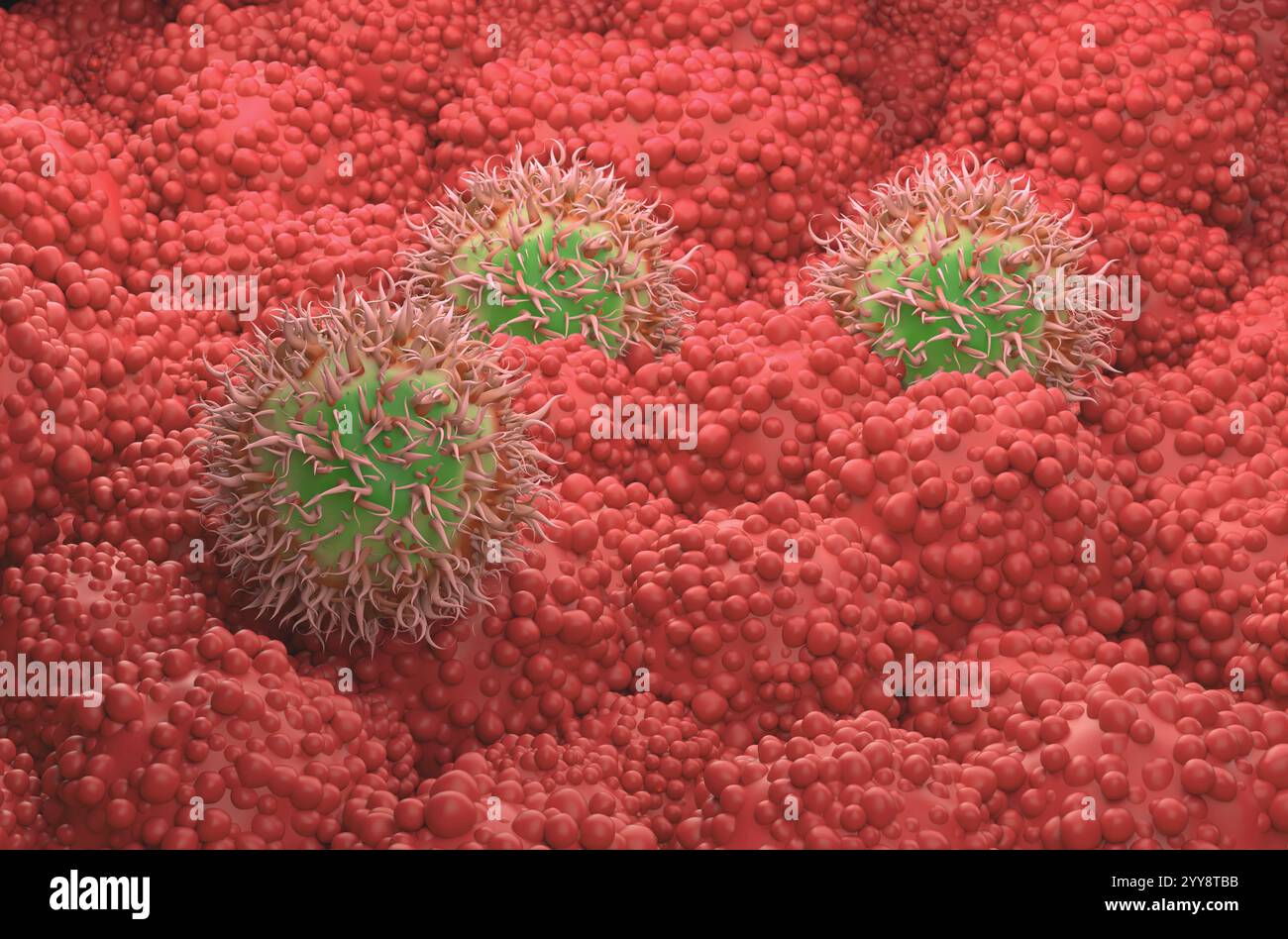 Cancro del pancreas - Vista isometrica illustrazione 3d. Foto Stock